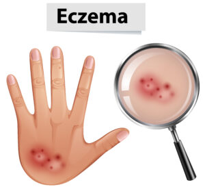 SKIN CONDITIONS: A Human Hand with Eczema